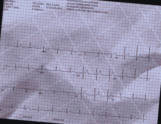 Normal ECG — PTB-XL