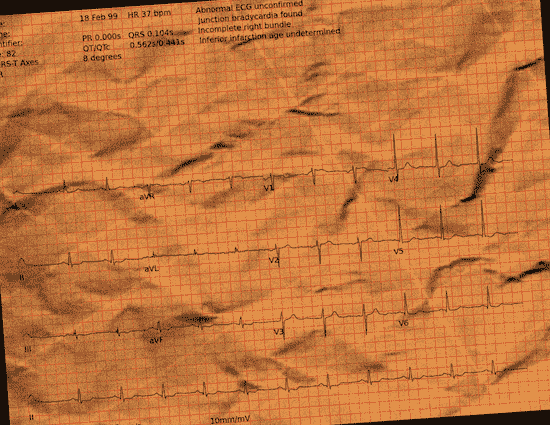 Normal ECG — PTB-XL