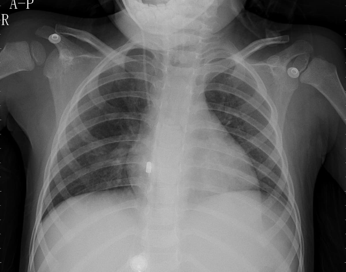 Pneumonia — NIH Chest X-ray14
