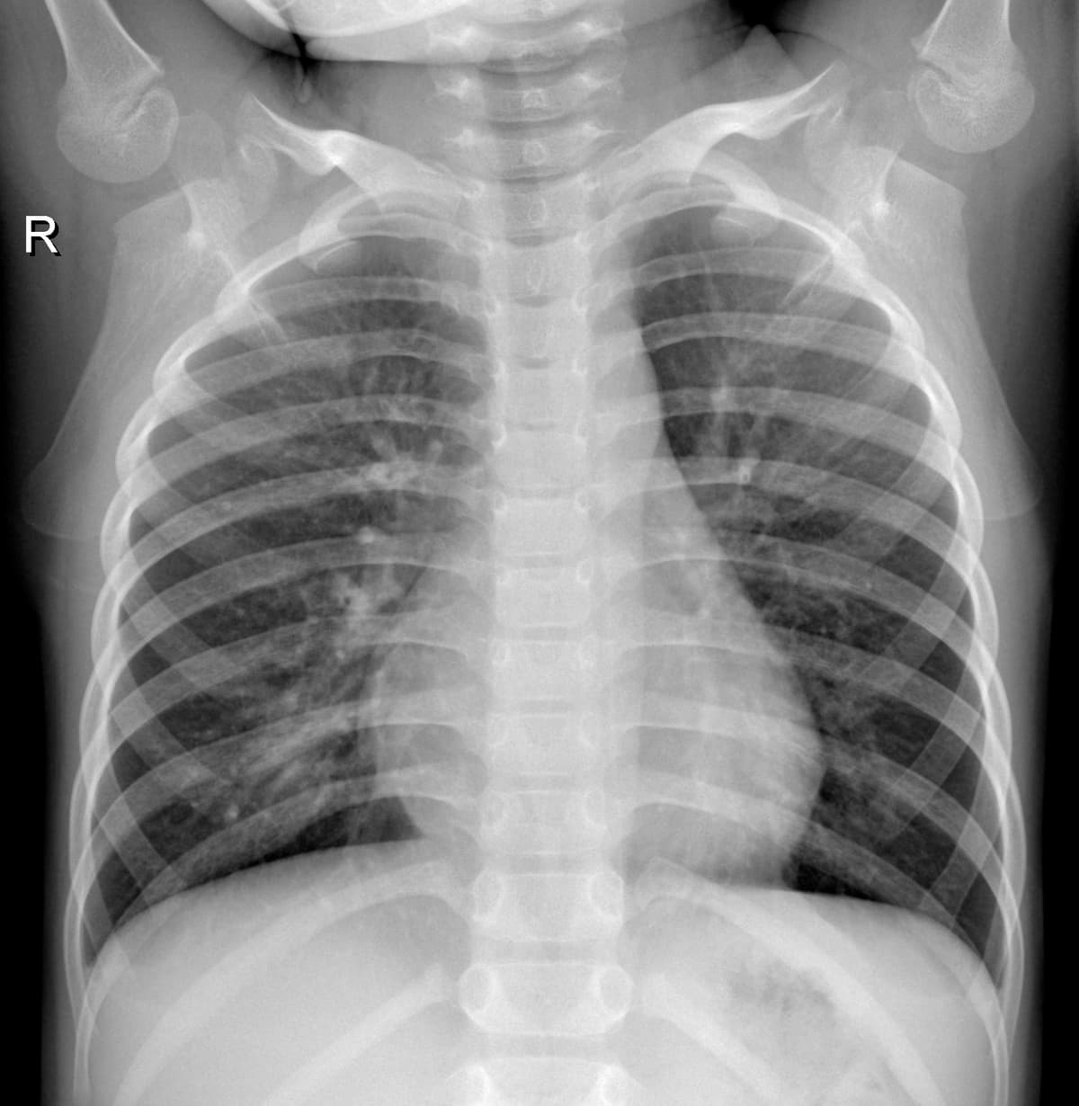 Radiografia Normal — NIH Chest X-ray14