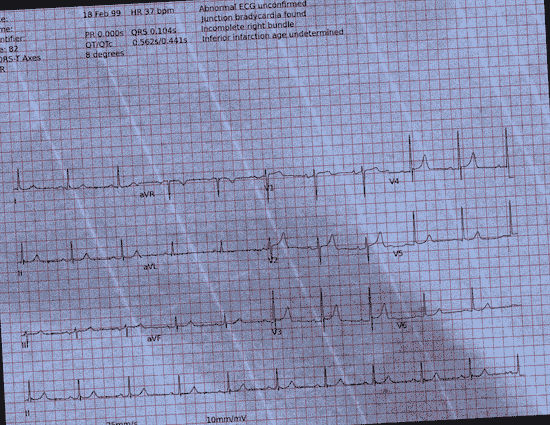 Normal ECG — PTB-XL