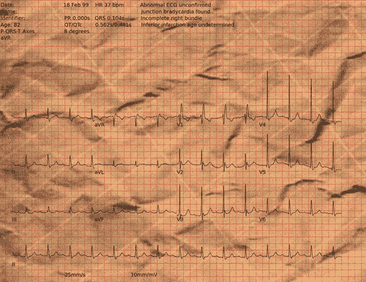Normal ECG — PTB-XL