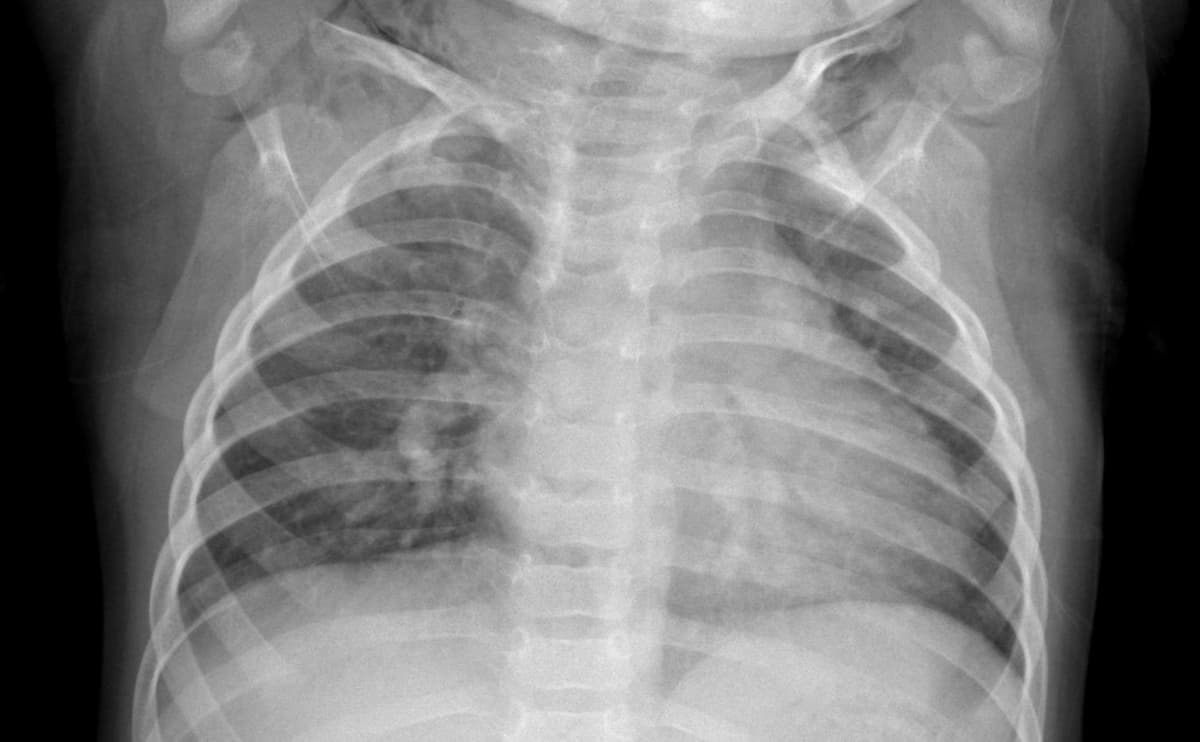 Pneumonia — NIH Chest X-ray14