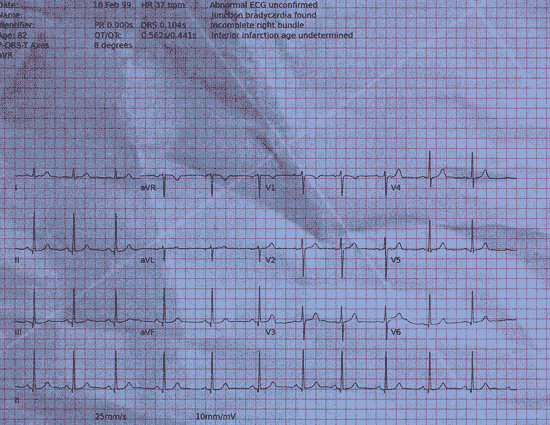 Normal ECG — PTB-XL