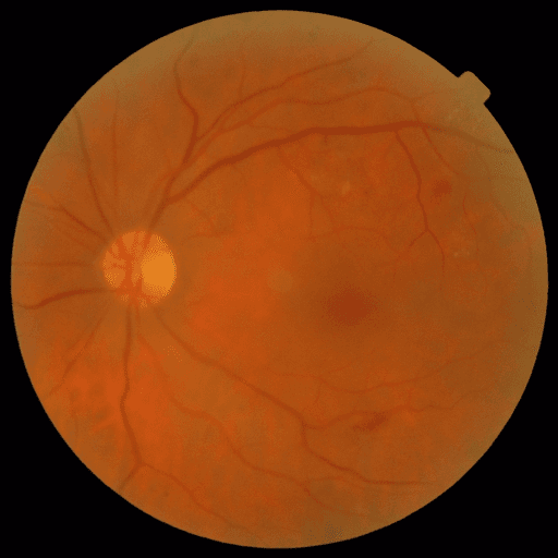 No Diabetic Retinopathy — MESSIDOR-2