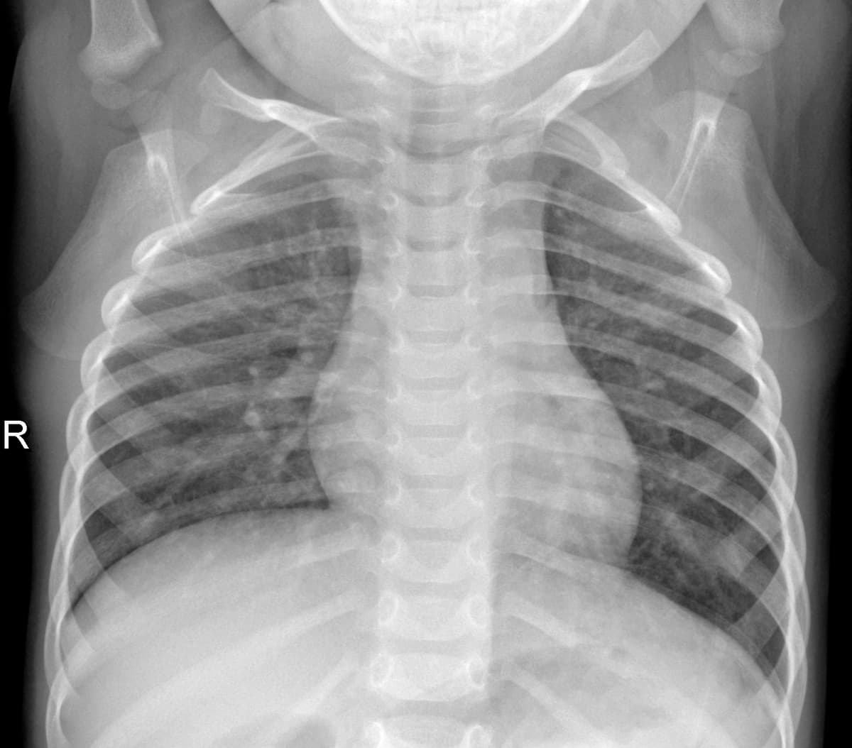 Radiografia Normal — NIH Chest X-ray14