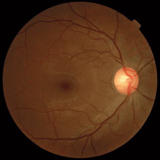 Proliferative DR — MESSIDOR-2