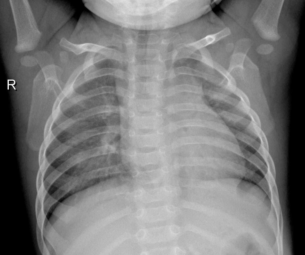 Radiografia Normal — NIH Chest X-ray14
