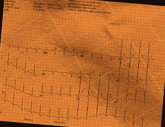 Normal ECG — PTB-XL