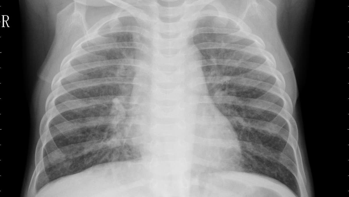Pneumonia — NIH Chest X-ray14