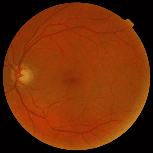 No Diabetic Retinopathy — MESSIDOR-2
