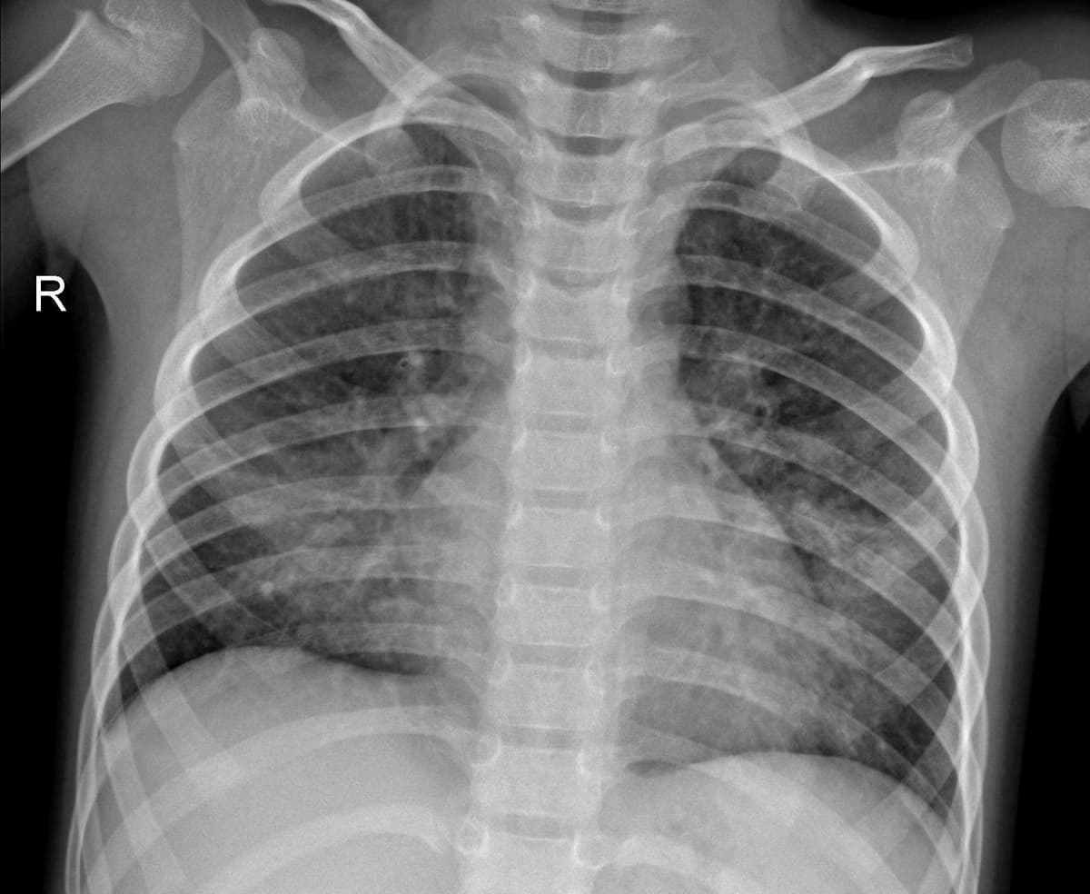 Pneumonia — NIH Chest X-ray14