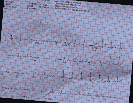 Normal ECG — PTB-XL