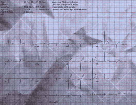 Normal ECG — PTB-XL