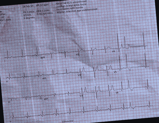 Normal ECG — PTB-XL