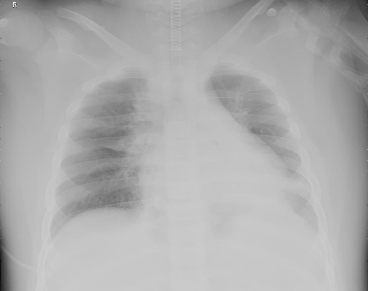 Pneumonia — NIH Chest X-ray14
