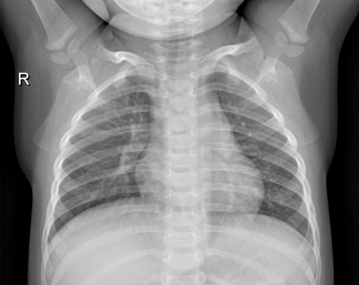 Radiografia Normal — NIH Chest X-ray14