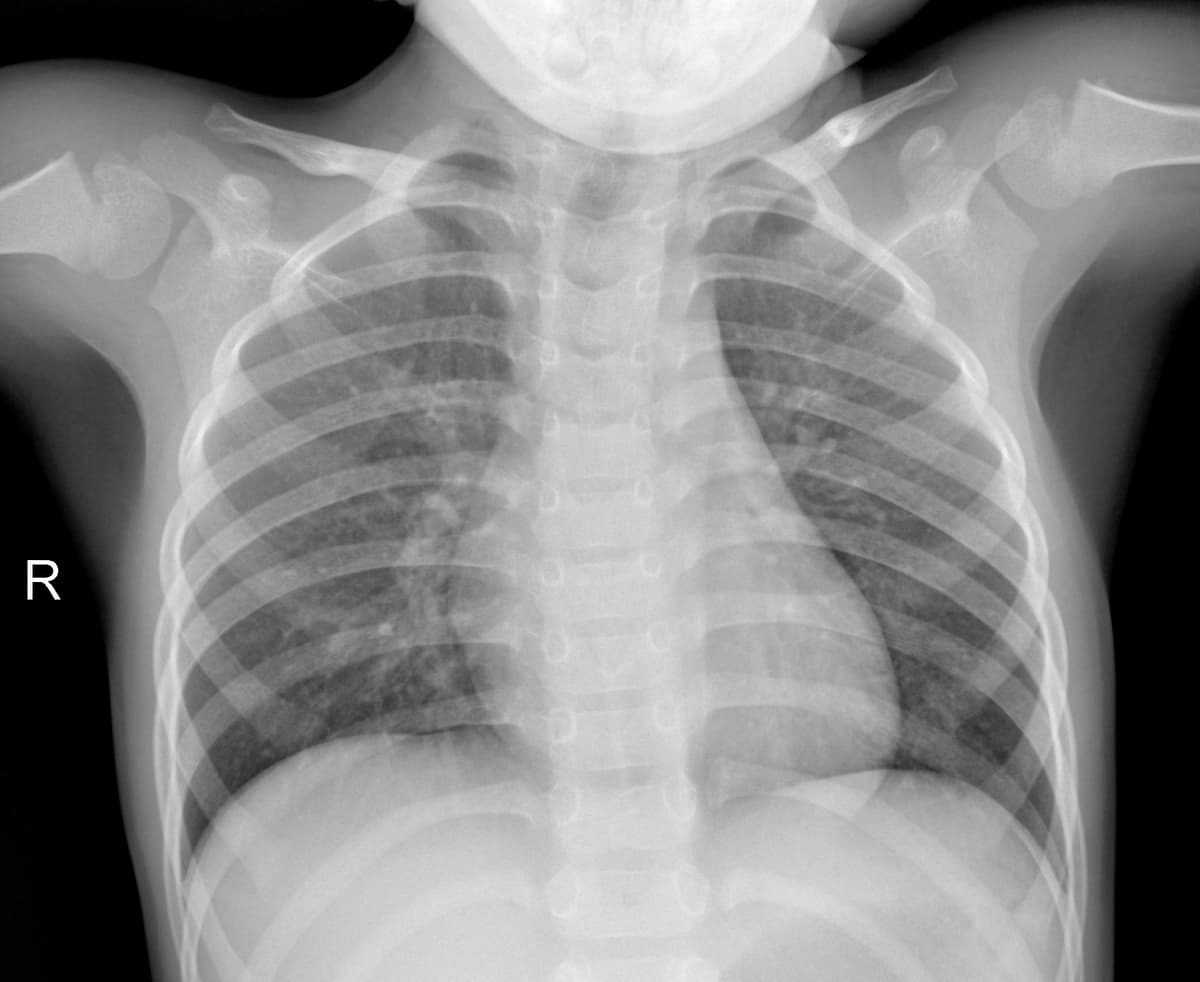 Radiografia Normal — NIH Chest X-ray14
