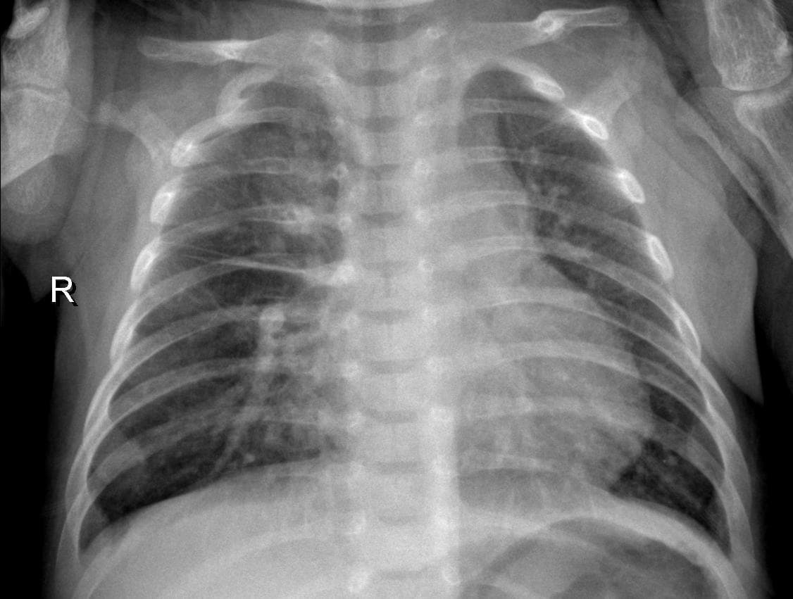 Pneumonia — NIH Chest X-ray14
