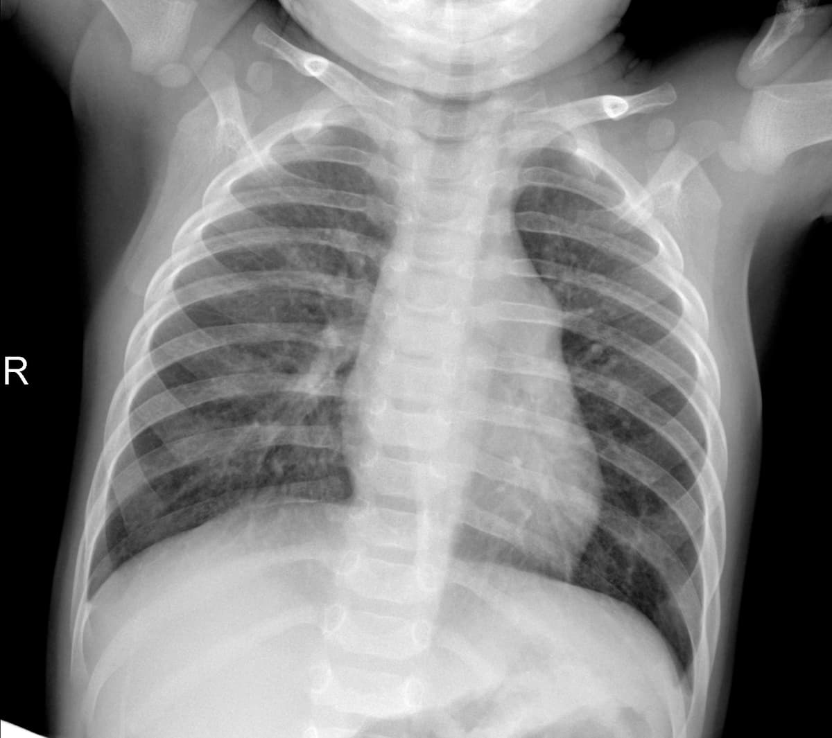 Radiografia Normal — NIH Chest X-ray14