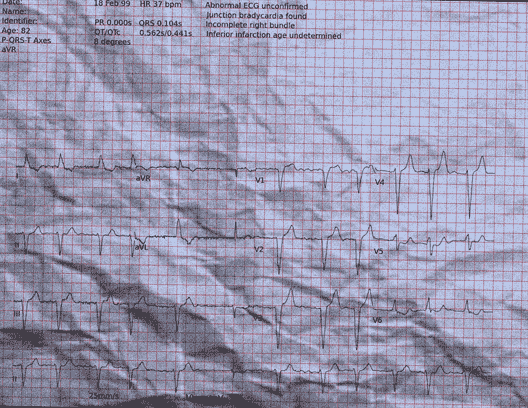 Normal ECG — PTB-XL