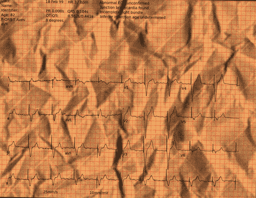 Normal ECG — PTB-XL
