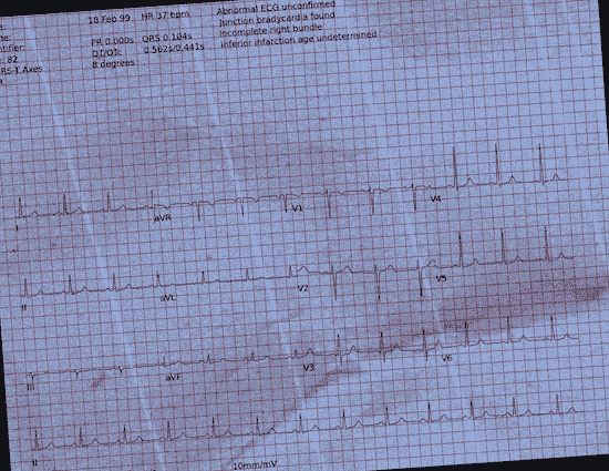Normal ECG — PTB-XL