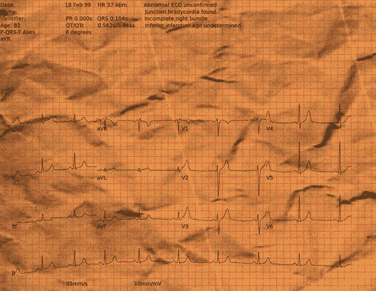 Normal ECG — PTB-XL
