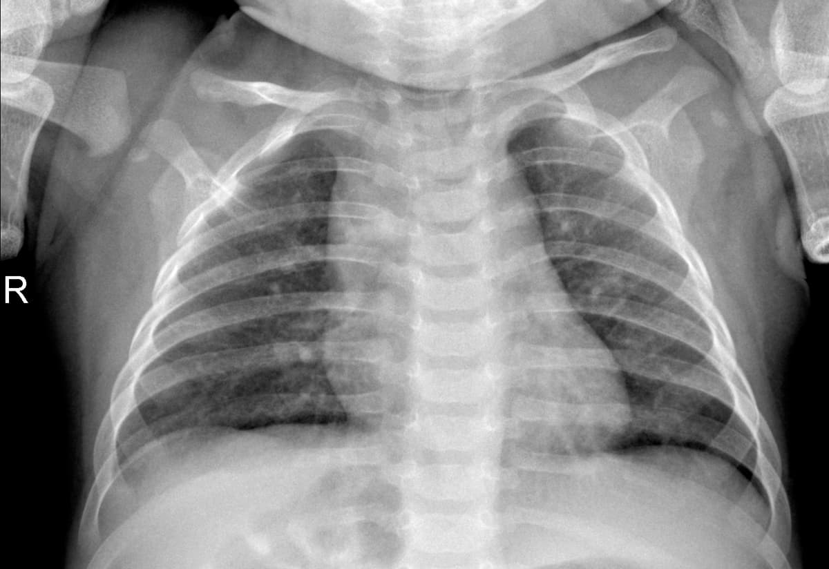 Radiografia Normal — NIH Chest X-ray14