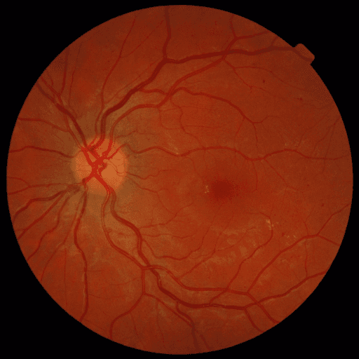 No Diabetic Retinopathy — MESSIDOR-2