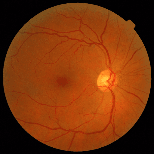 No Diabetic Retinopathy — MESSIDOR-2