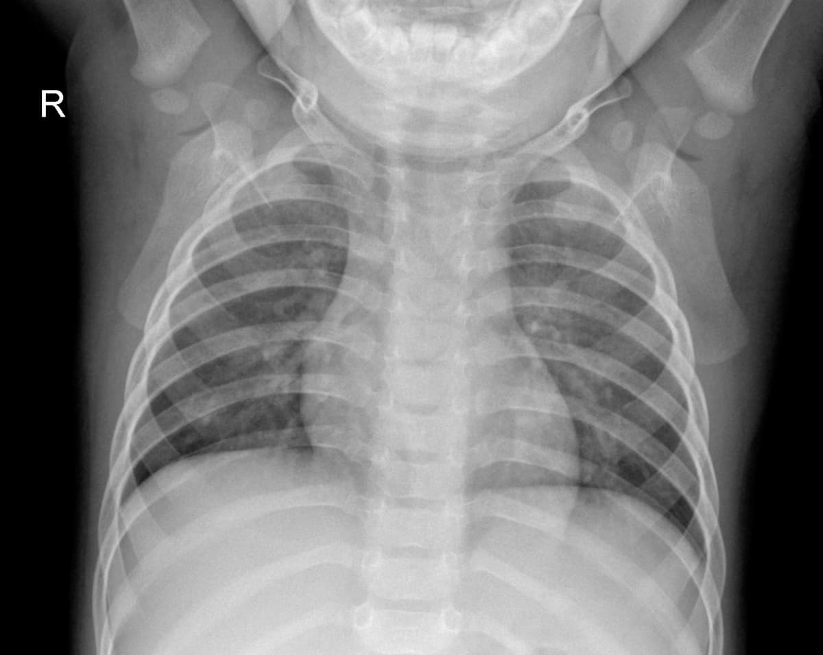 Radiografia Normal — NIH Chest X-ray14