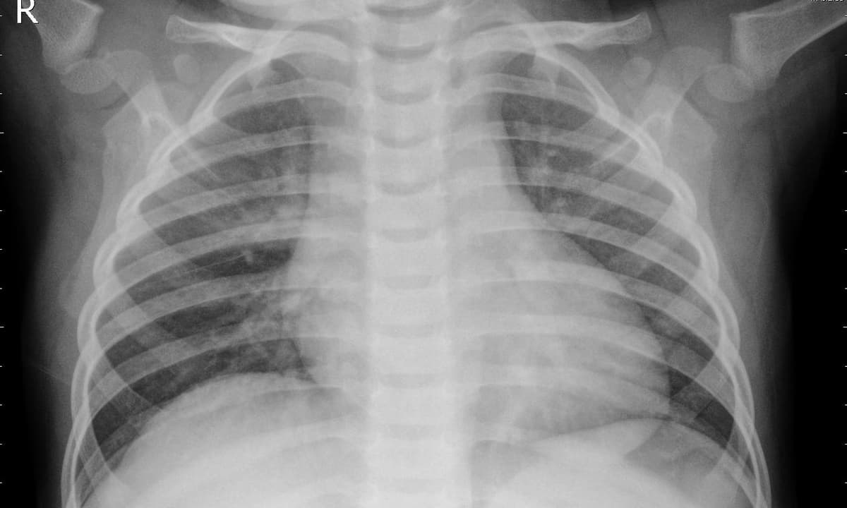 Pneumonia — NIH Chest X-ray14