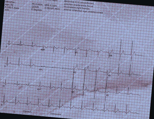 Normal ECG — PTB-XL