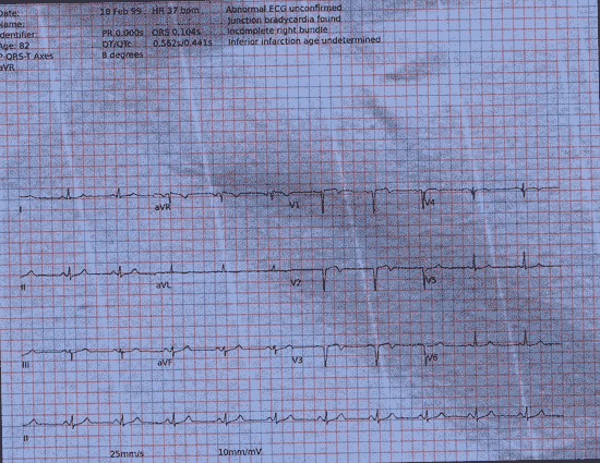 Normal ECG — PTB-XL