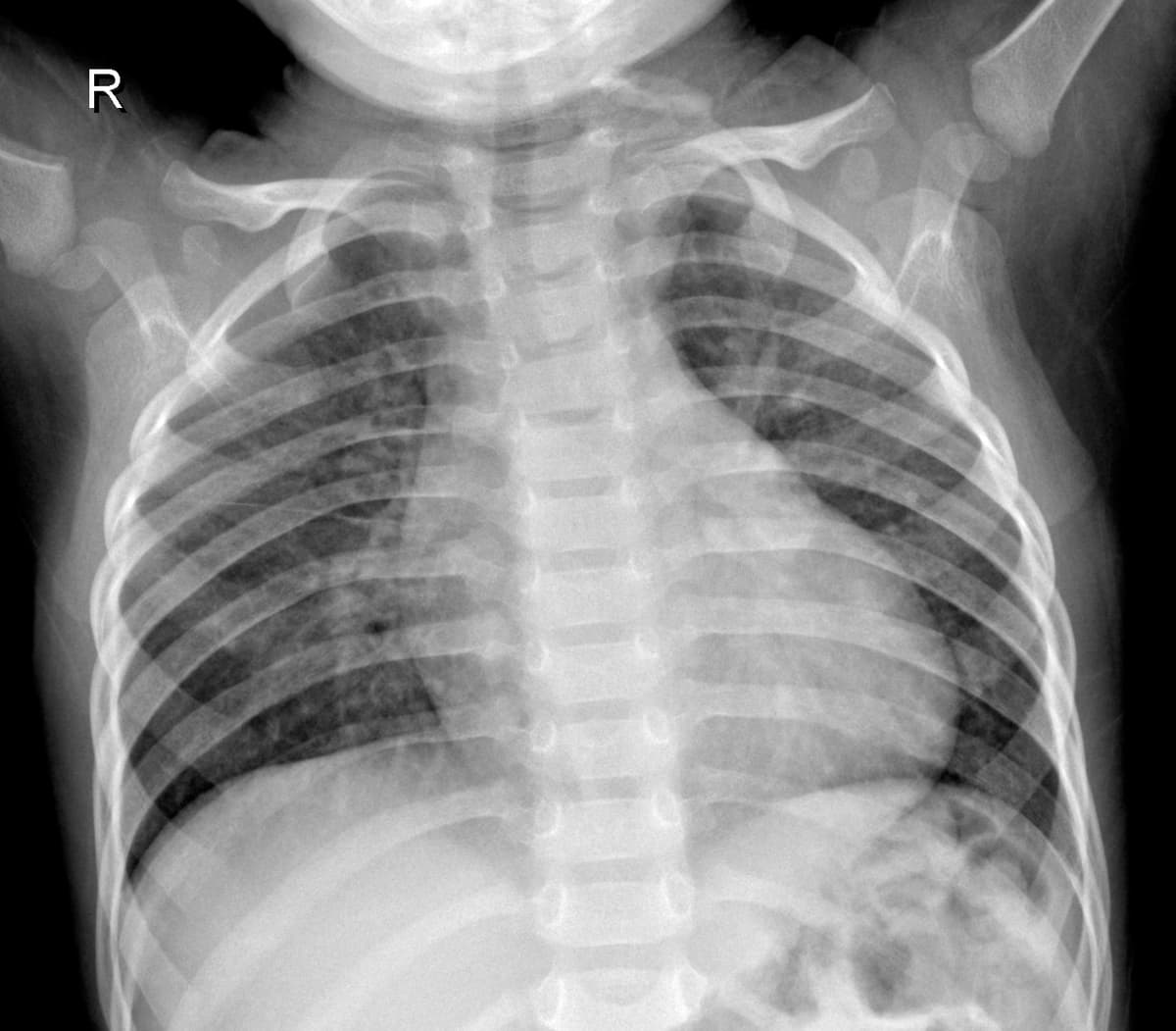 Radiografia Normal — NIH Chest X-ray14