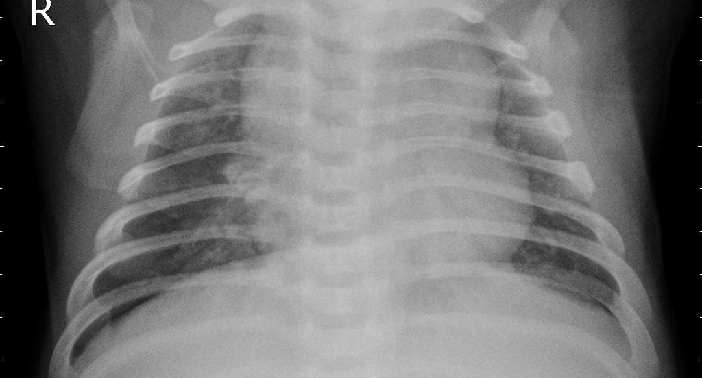 Pneumonia — NIH Chest X-ray14