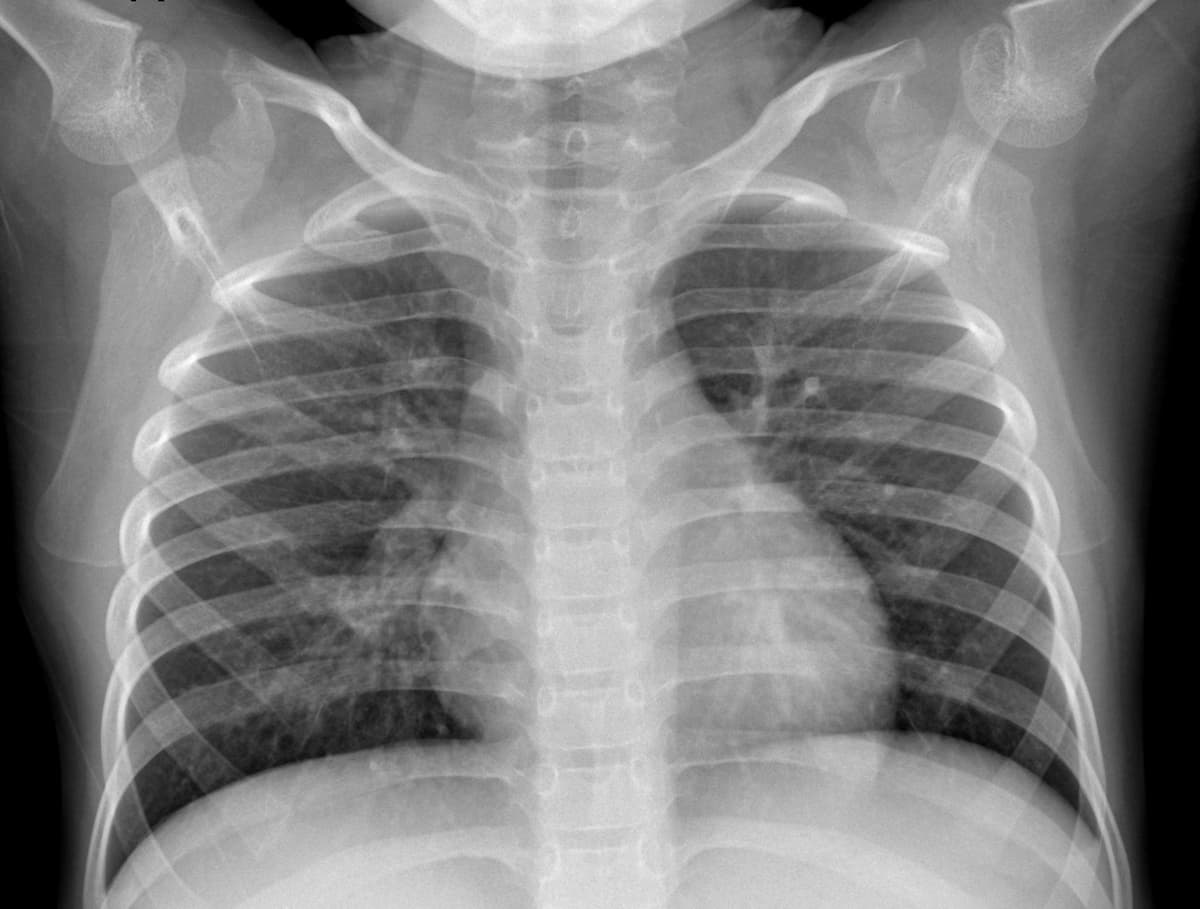 Pneumonia — NIH Chest X-ray14