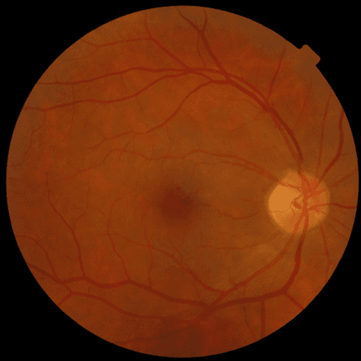 No Diabetic Retinopathy — MESSIDOR-2