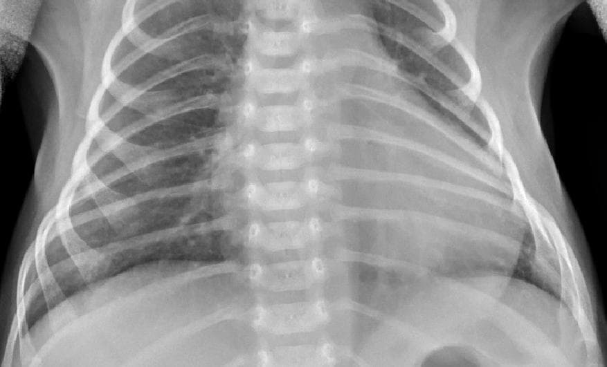 Pneumonia — NIH Chest X-ray14