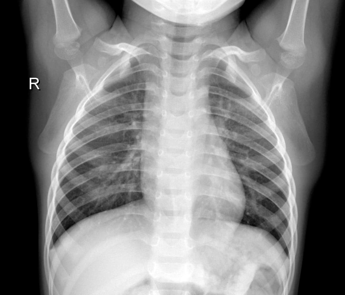 Radiografia Normal — NIH Chest X-ray14