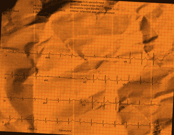 Normal ECG — PTB-XL