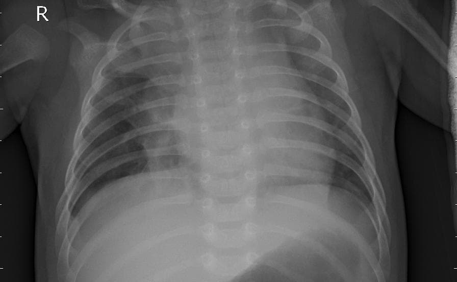 Pneumonia — NIH Chest X-ray14