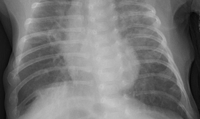 Pneumonia — NIH Chest X-ray14