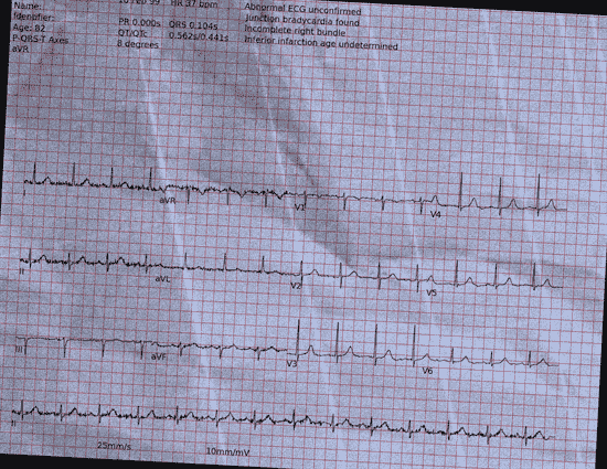 Normal ECG — PTB-XL