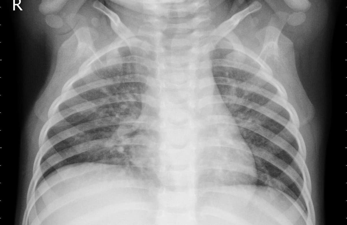 Pneumonia — NIH Chest X-ray14