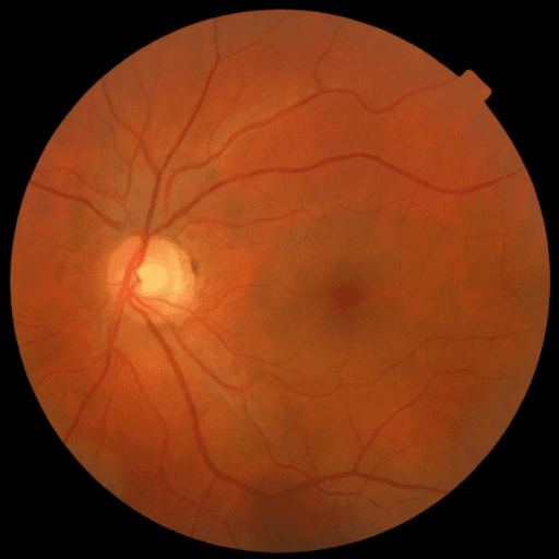 No Diabetic Retinopathy — MESSIDOR-2