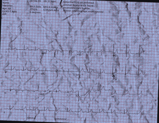 Normal ECG — PTB-XL