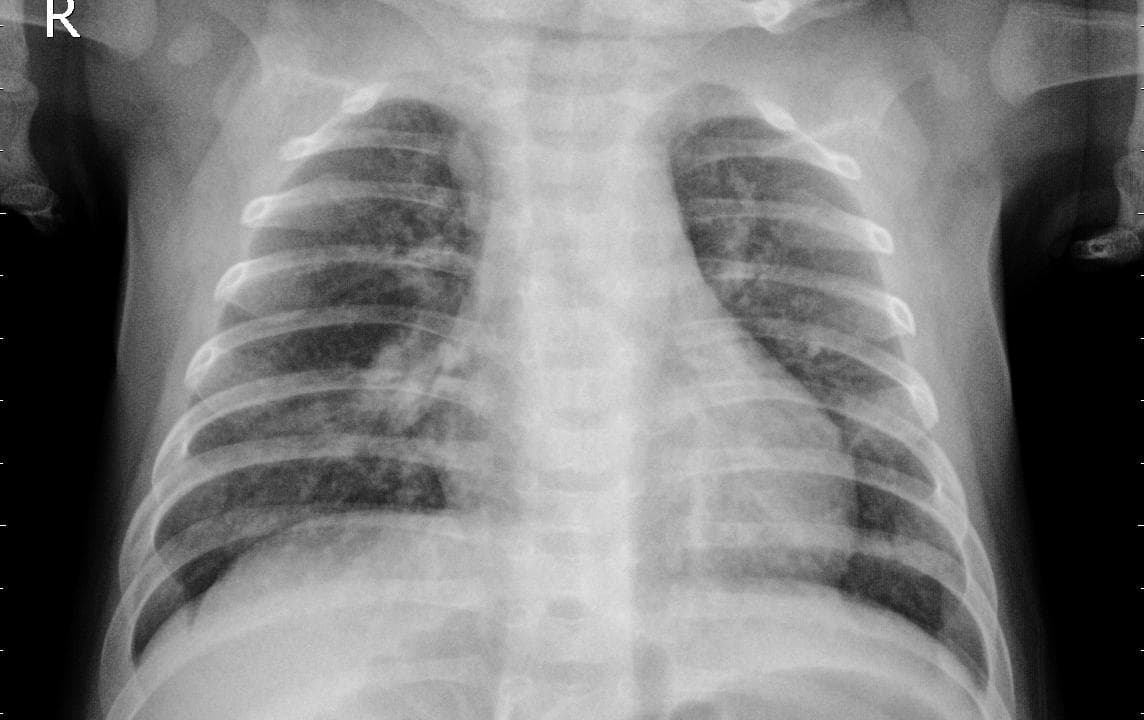 Pneumonia — NIH Chest X-ray14