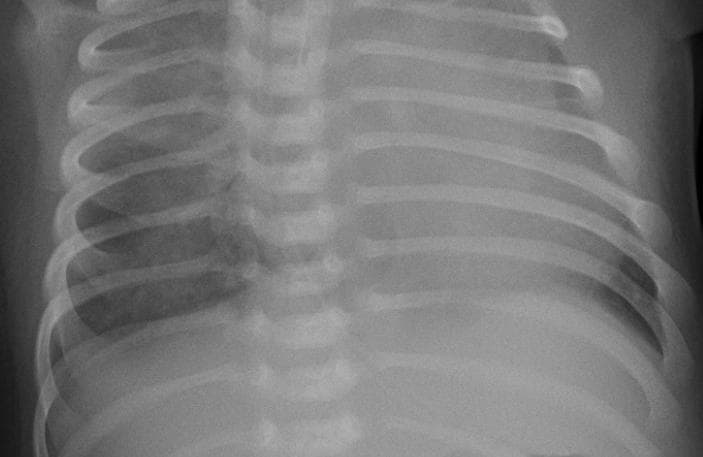 Pneumonia — NIH Chest X-ray14